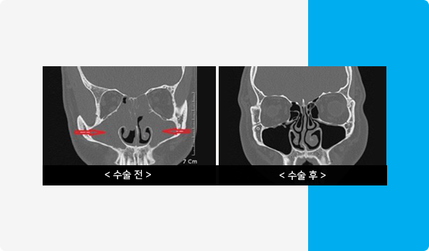 축농증수술 부비동염