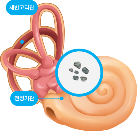 내이안에 생긴 이석증 설명